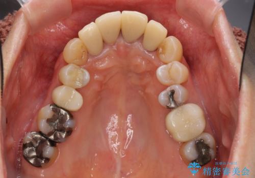 矯正を含む全顎治療の治療中