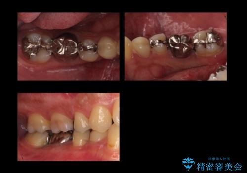 虫歯がひどく抜歯 奥歯をブリッジにの症例 治療前