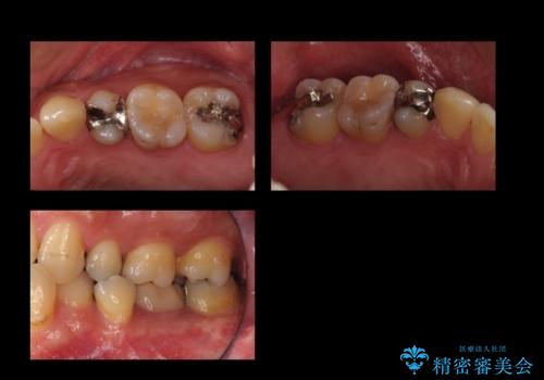 奥歯の詰め物のやりかえ セラミックインレー、ゴールドインレーの治療前