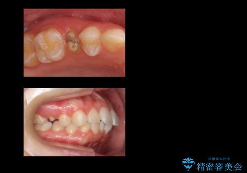 歯の高さがなく、しょっちゅう外れる 他院で治療途中だが病院を変えたいの治療前