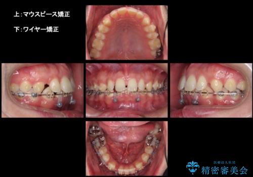 すきっ歯・出っ歯 コンプレックスの前歯を治したい 目立たない方法で セラミック治療は不可能な症例の治療中