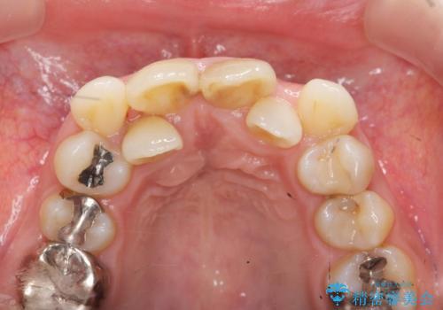 子供の頃にぶつけた前歯 根管治療から行うセラミック治療の治療前