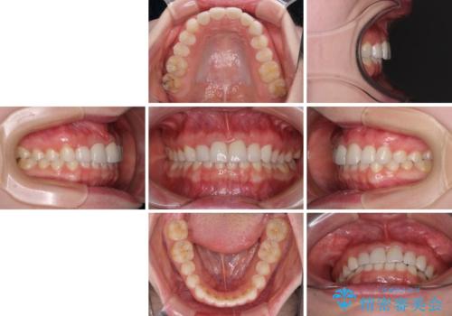 気になる前歯を美しく マウスピース矯正とセラミッククラウンの治療後