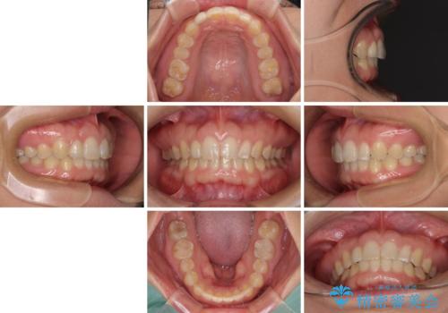 前歯の歯並びと小さい歯を改善 インビザラインとオールセラミッククラウンの治療後