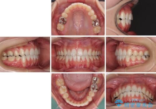 上下の八重歯を治したい　補助装置を用いたインビザライン矯正の治療後