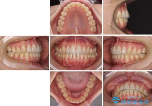 気になるデコボコとオープンバイト インビザラインでの矯正治療の治療後