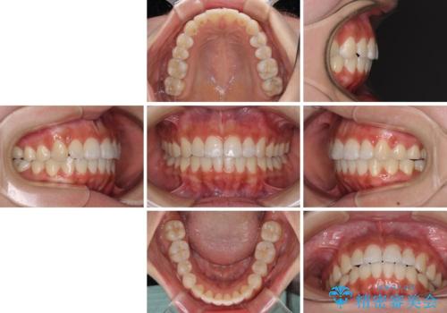 前歯のデコボコが気になる インビザラインによる矯正治療の治療後