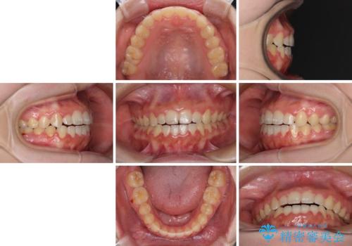 外科矯正は受けたくない 上顎骨拡大による妥協的な受け口治療の治療後