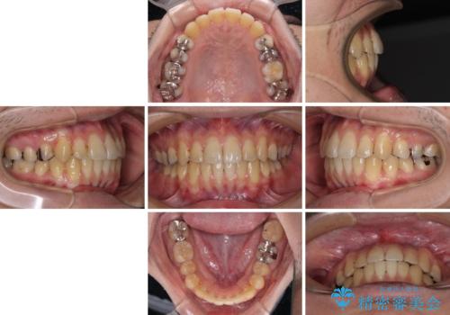 前歯のクロスバイトをインビザラインで矯正治療の治療後