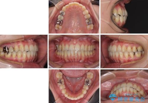 切端咬合をインビザライン矯正で解消の治療後