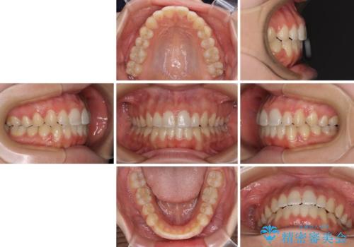 【モニター】オープンバイトをインビザラインで矯正治療の治療後