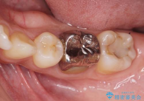 笑った時に目立つ銀歯を白くしたいの症例 治療前