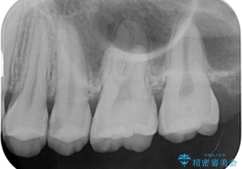 【セラミックインレー】虫歯の治療の治療前