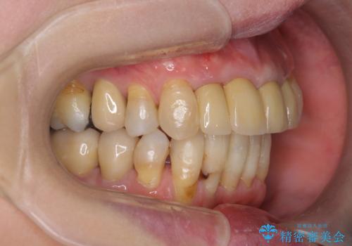 矯正を含む全顎治療の治療後