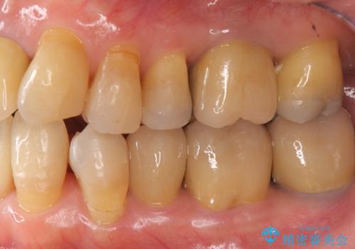 矯正を含む全顎治療の治療後