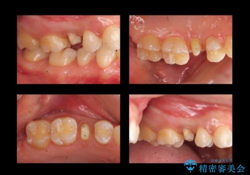 歯の高さがなく、しょっちゅう外れる 他院で治療途中だが病院を変えたいの治療中