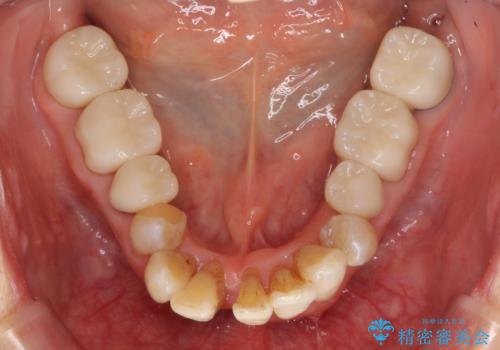 矯正を含む全顎治療の治療中