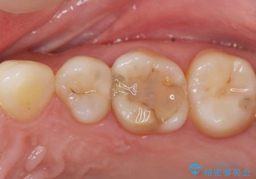 セラミックインレーとゴールドインレーの症例 治療前