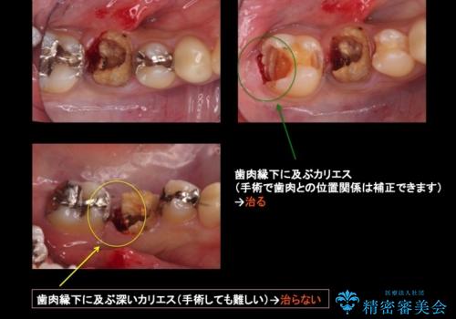 虫歯がひどく抜歯 奥歯をブリッジにの治療中