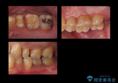 奥歯の詰め物のやりかえ セラミックインレー、ゴールドインレーの治療中