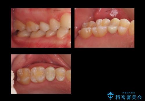 歯の高さがなく、しょっちゅう外れる 他院で治療途中だが病院を変えたいの治療中