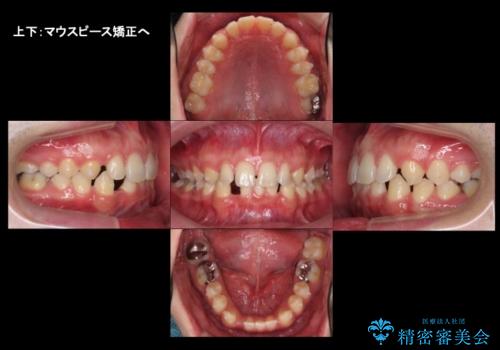 すきっ歯・出っ歯 コンプレックスの前歯を治したい 目立たない方法で セラミック治療は不可能な症例の治療中