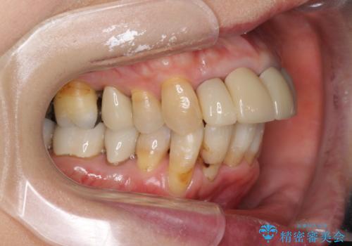 矯正を含む全顎治療の治療中