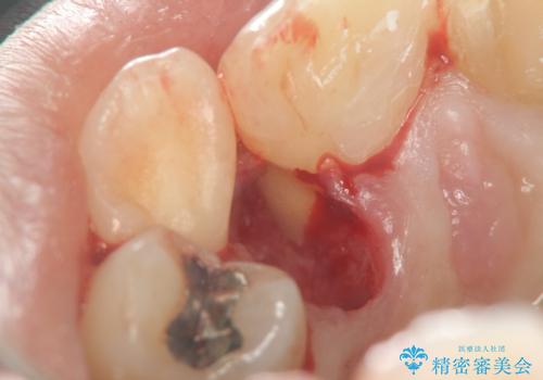 子供の頃にぶつけた前歯 根管治療から行うセラミック治療の治療前