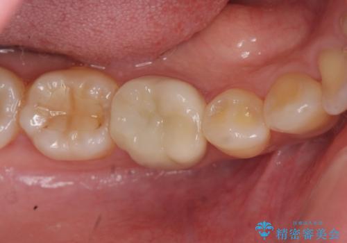 目立つ銀歯を白くしたいの治療後