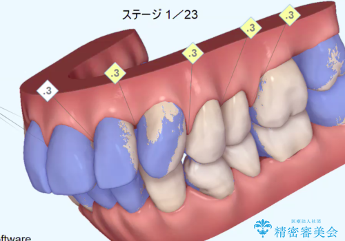 矯正を含む全顎治療