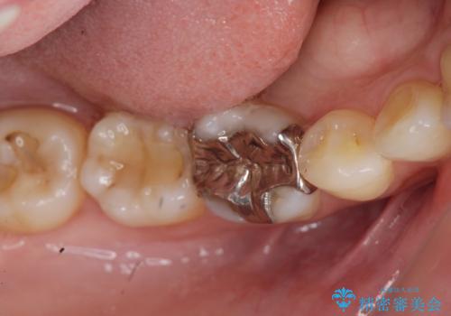 目立つ銀歯を白くしたいの治療前