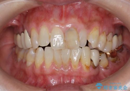 前歯の変色 セラミッククラウンによる審美回復の症例 治療前