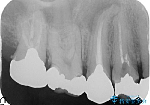 オールセラミッククラウン ブリッジによる欠損歯の補綴の治療前