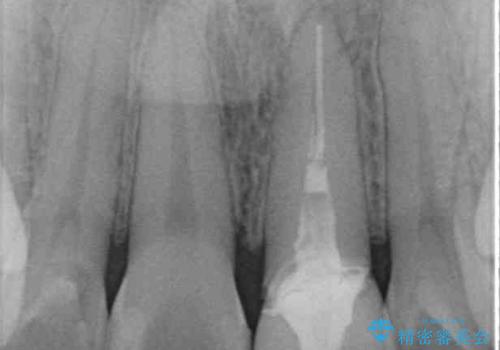 境目が見えている前歯のクラウンをオールセラミッククラウンにの治療前