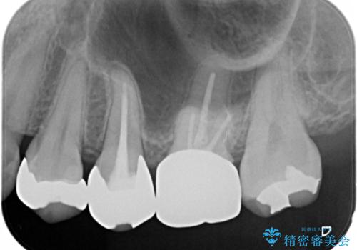 笑うとキラリと光る銀歯を何とかしたい:適合の良いセラミックで長持ちする歯にの治療前