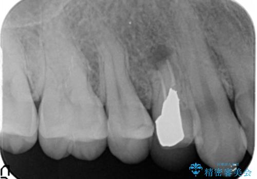 他院の根の治療で一向に治らない、さらに歯根を切ってもらったが良くならないの治療前