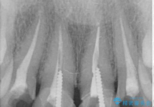 変色した歯をセラミックできれいにの治療前