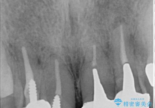 オールセラミッククラウン セラミックで前歯の見た目を改善の治療前