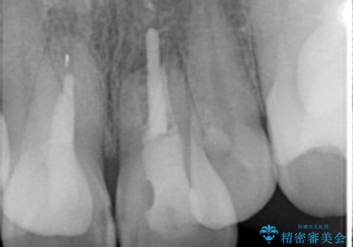 子供の頃にぶつけた前歯 根管治療から行うセラミック治療の治療前