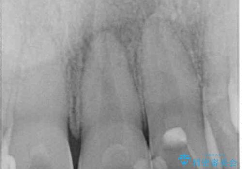 前歯の変色が気になる オールセラミッククラウンによる審美歯科治療の治療前