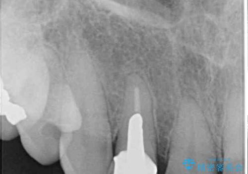 歯肉が腫れている前歯 外科処置を併用したオールセラミッククラウンの治療前