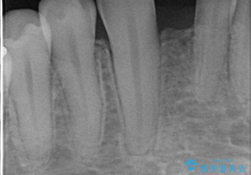 下の前歯のインプラント　生まれつき歯が少ないの治療前