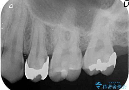 奥歯の詰め物のやりかえ セラミックインレー、ゴールドインレーの治療前