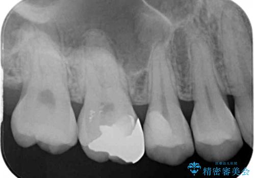 虫歯がしみる　セラミックインレーによる修復治療の治療後