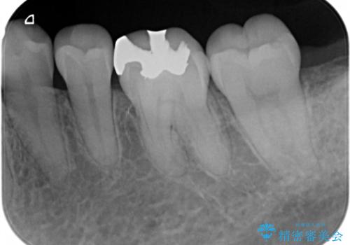 適合のよいセラミックで自分の歯となじむ自然な仕上がりにの治療前