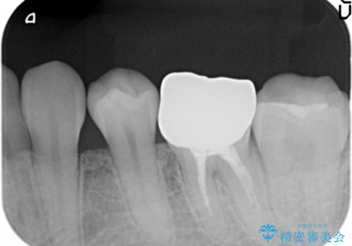 笑った時に目立つ銀歯を白くしたいの治療前