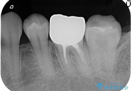 笑った時に目立つ銀歯を白くしたいの治療後