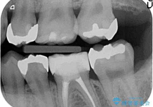 奥歯の詰め物のやりかえ　セラミックインレー、ゴールドインレーの治療前