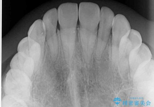 外科矯正は受けたくない 上顎骨拡大による妥協的な受け口治療の治療後
