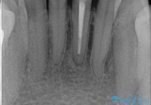 オールセラミッククラウン 変色した前歯をセラミックで白くの治療前